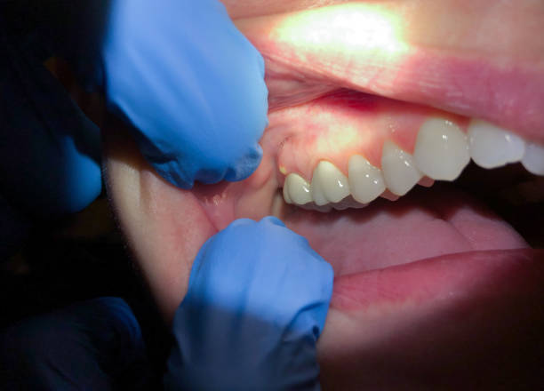 Best Emergency Gum Treatment in Cadott, WI